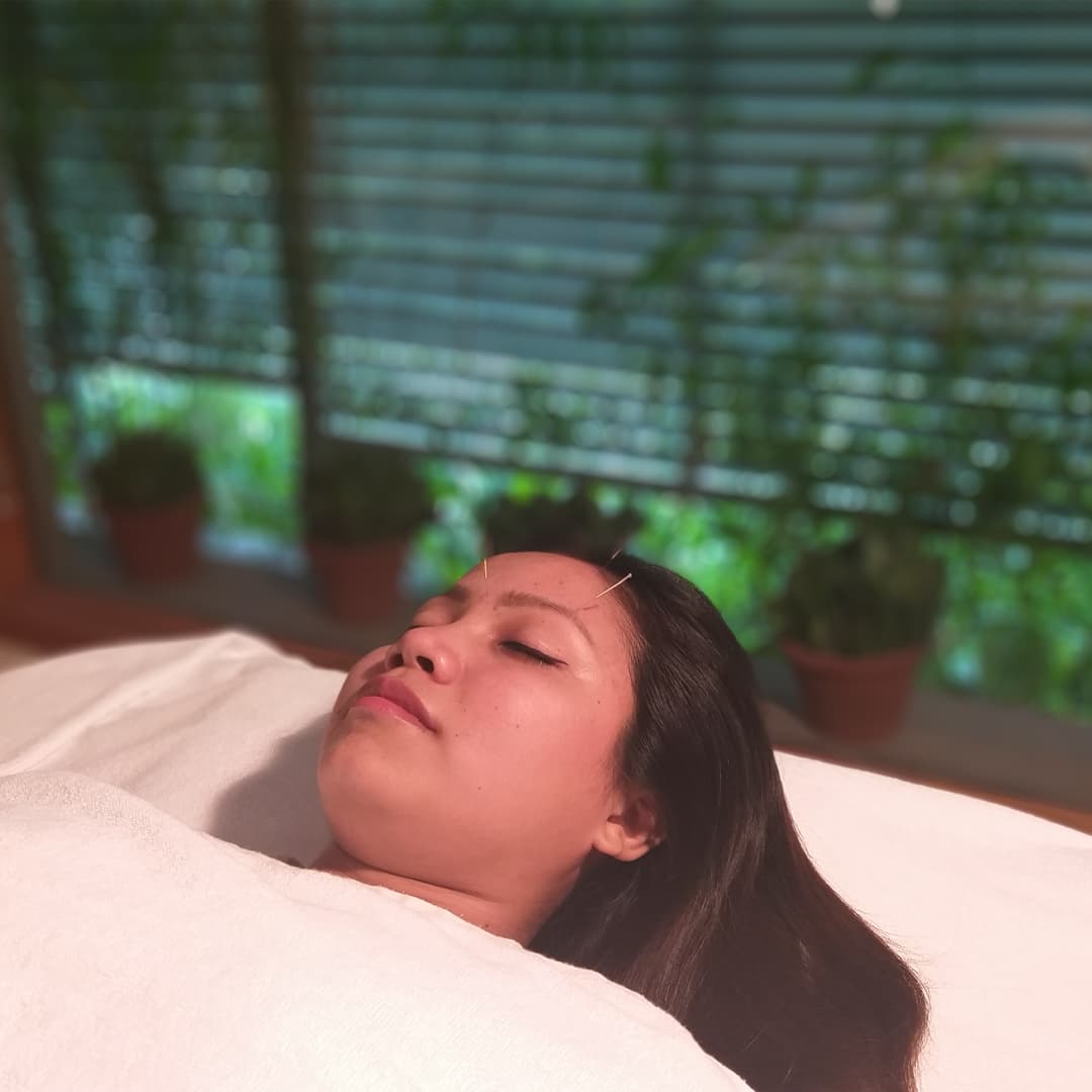 Acupuncture